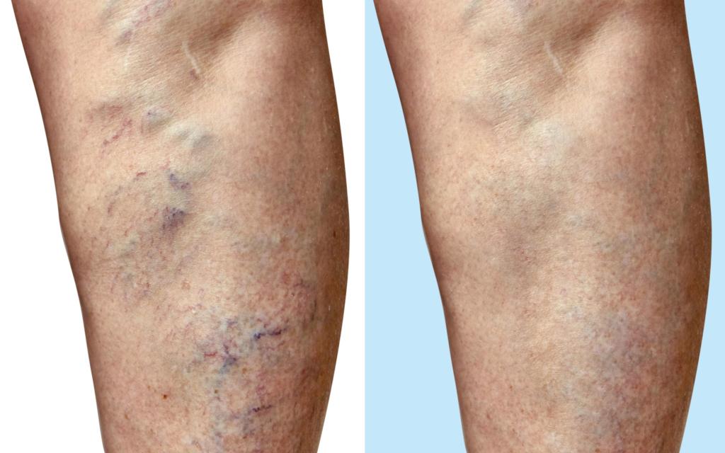 One week after varicose vein procedure