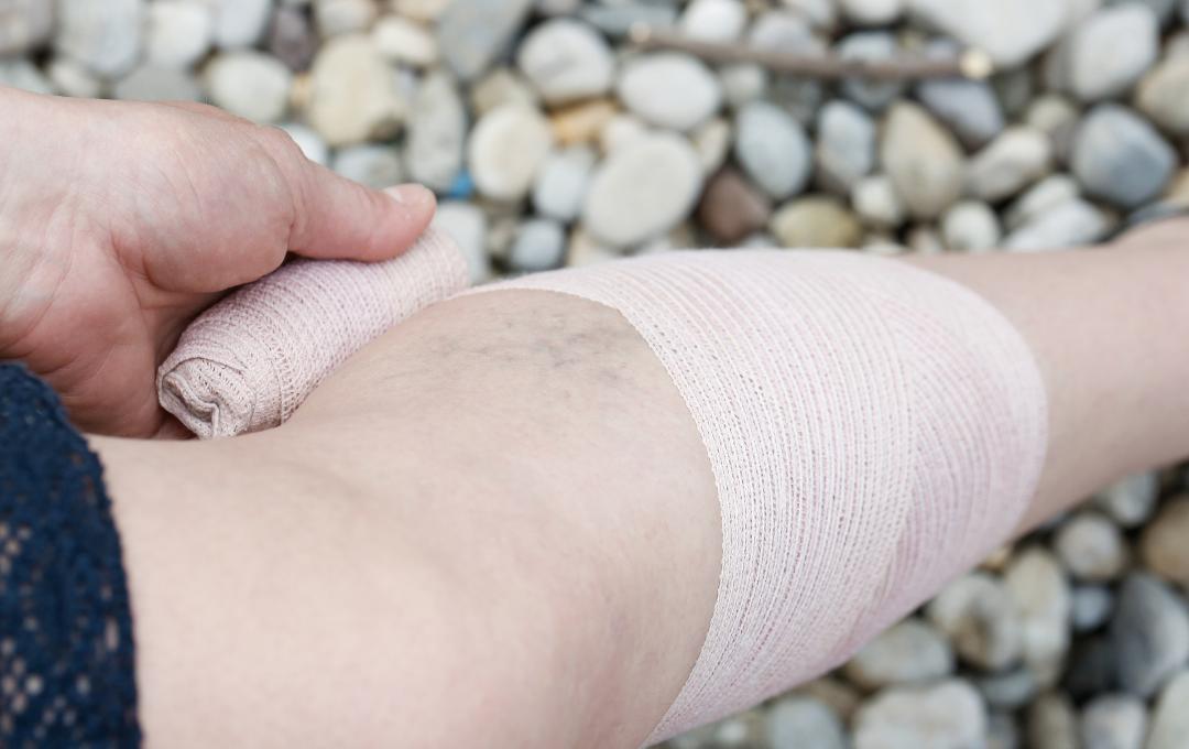 Compression bandages after varicose vein surgery