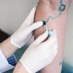 image representing non visible varicose veins