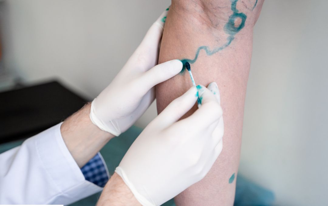 image representing non visible varicose veins