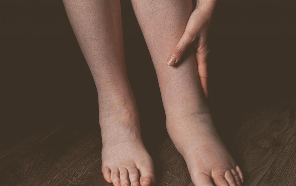 How to Manage Leg Swelling in Hot Weather: Heat Edema Relief