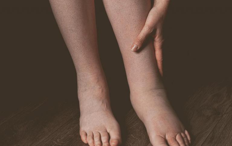 Manage Leg Swelling In The Heat: Tips For Heat Edema Relief