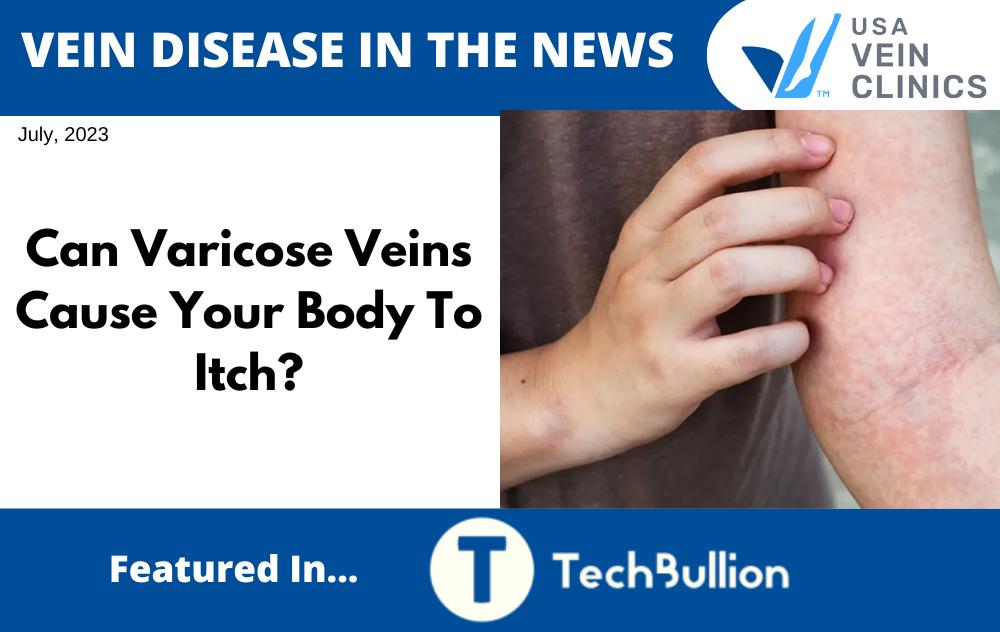 VARICOSE VEINS CAUSE ITCH