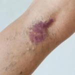 Can Varicose Veins Burst Causes, Symptoms & What To Do