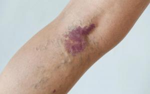 Vein Explodes Can Varicose Veins Burst? Causes, Symptoms & What To Do