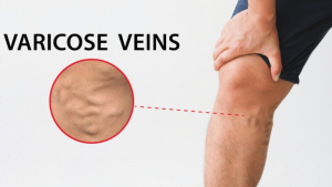How to Relieve Varicose Vein Pain