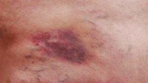 Signs & Symptoms of a Ruptured Varicose Vein