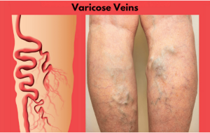 Why Do Varicose Veins Hurt