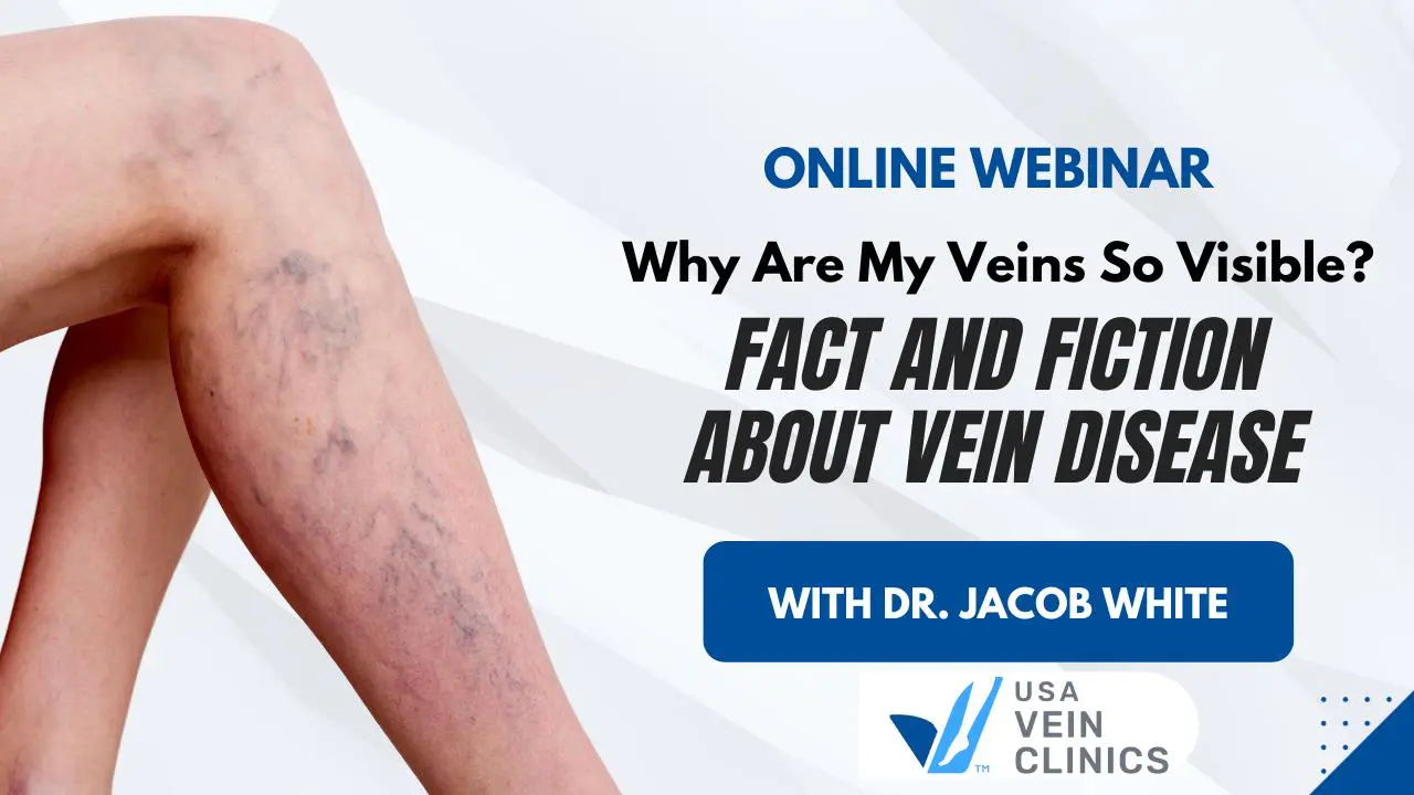 Spider Veins A Full Guide in 2023 - MD SPA