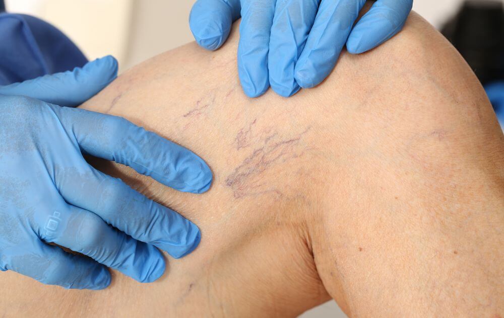 spider vein treatment cost