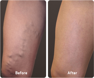 Before And After 7 Varicose Veins Before and After