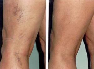 Before and After Spider Vein Treatment at USA Vein Clinics