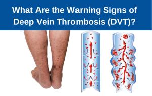 DVT warning signs