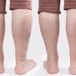 How Diet Impacts Vein Health: 11 Best Foods For Varicose Veins