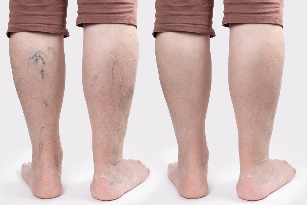 Before and after varicose vein procedure