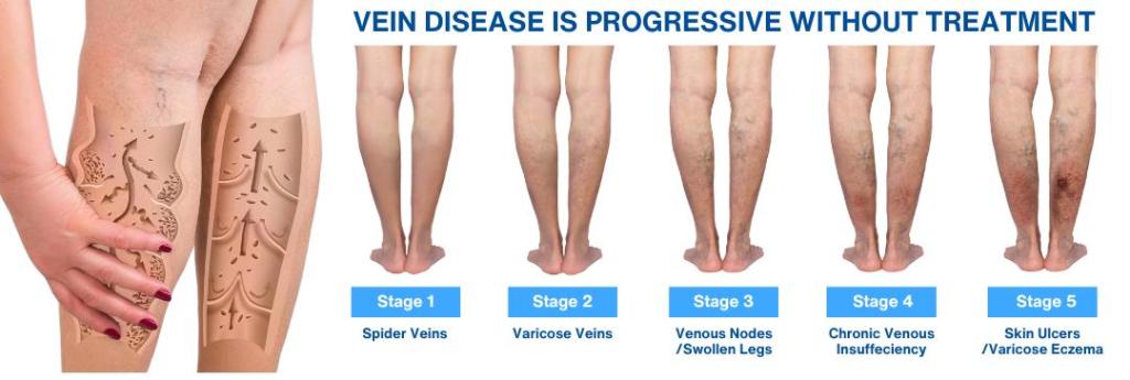 Vein disease revised