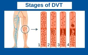 Stages of DVT