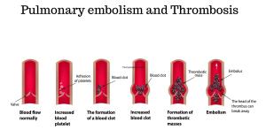 are varicose veins a sign of blood clots