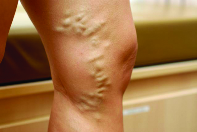 Varicose vein symptoms and condition