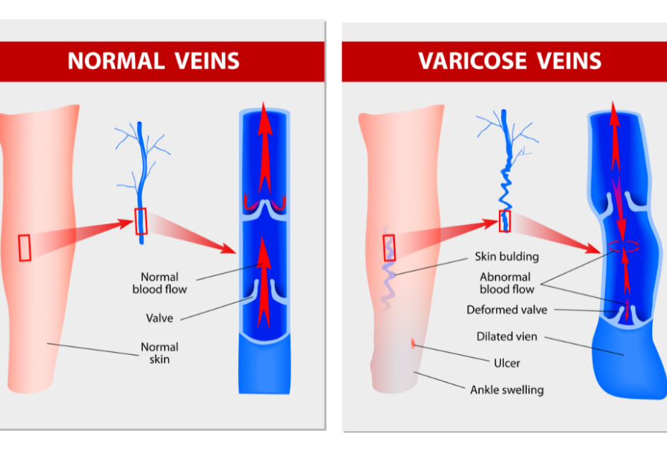 vein pain in leg