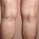 varicose veins and blood clots