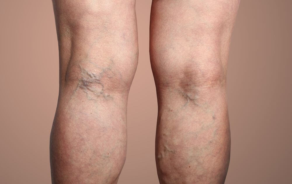 varicose veins and blood clots