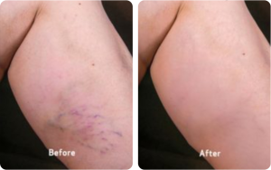 Spider Vein Before and After Treatment