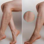 varicose vein treatment 1