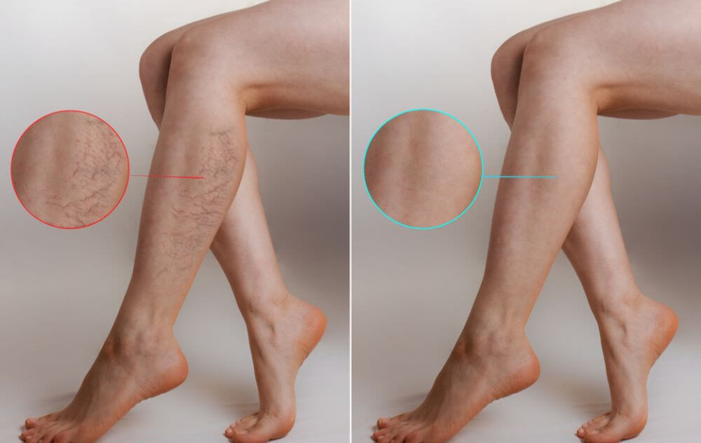 varicose vein treatment 1