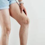 varicose vein leg pain