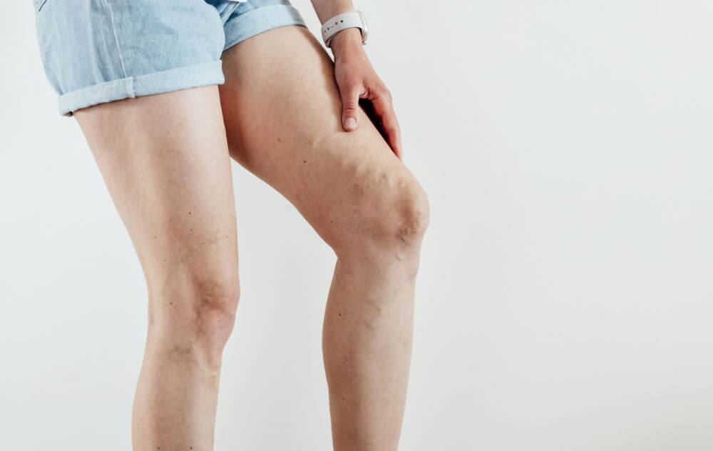 varicose vein leg pain