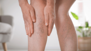 Are Hereditary Vein Issues Treatable