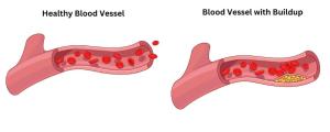 blood vessel disorders