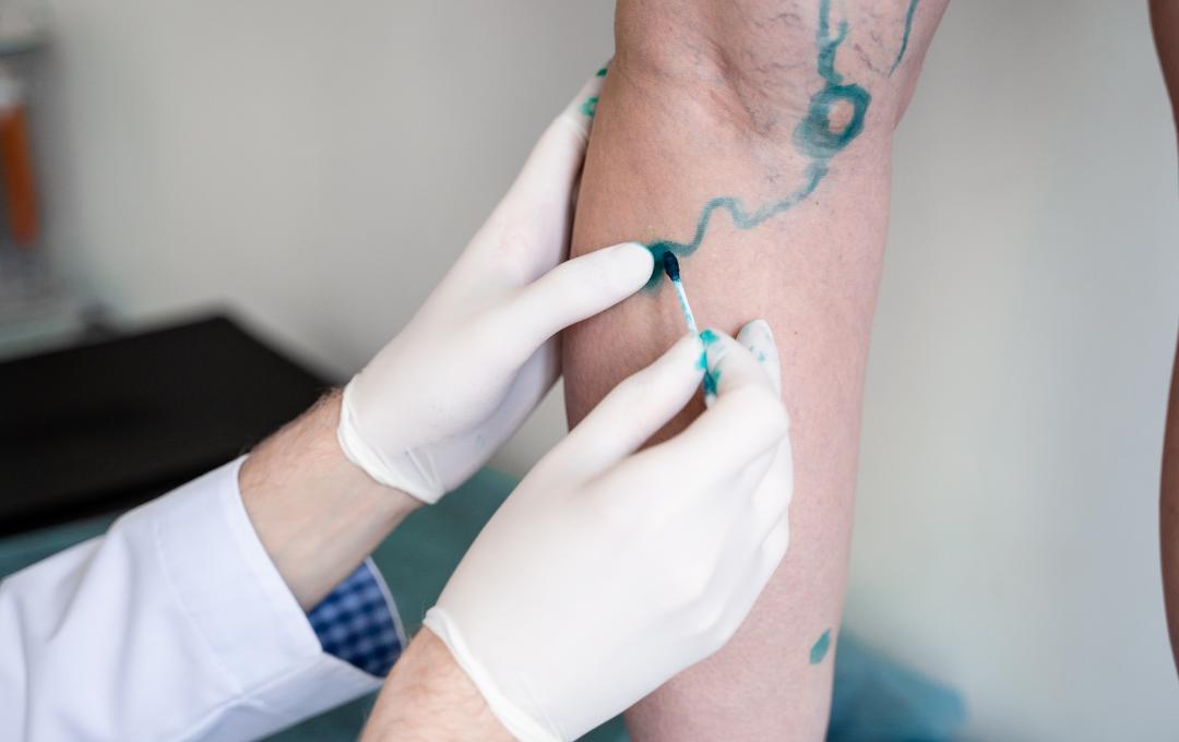 how to treat varicose veins that burn