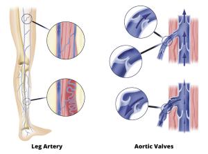 Leg Arteries