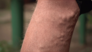 When Do You Need a Venous Ultrasound?