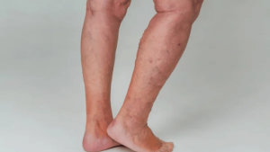 Why People with Diabetes Are at a Higher Risk for Vein Disease