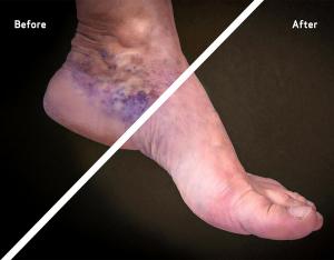 Before And After 10 Before and After vein treatment at USA Vein Clinics