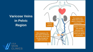 Are Varicose Veins Normal During Pregnancy