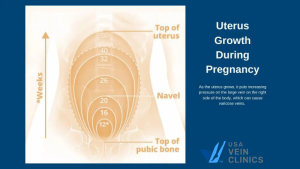 Dealing with Varicose Veins During Pregnancy