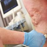 Second Opinion Vein Treatment