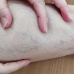 Why Are My Veins So Visible?