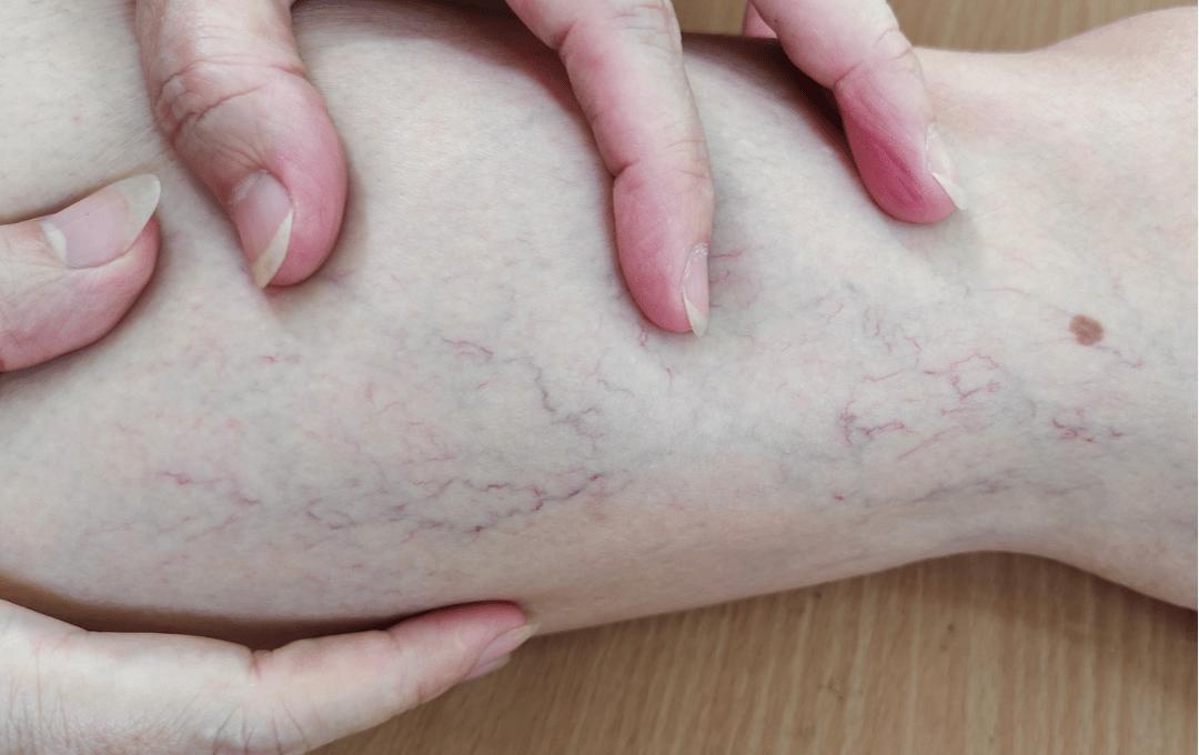 Why Are My Veins So Visible?