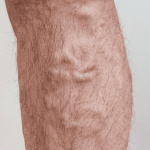 Why Are My Veins So Visible