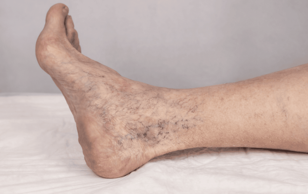 How Vein Health Impacts Your Immune System