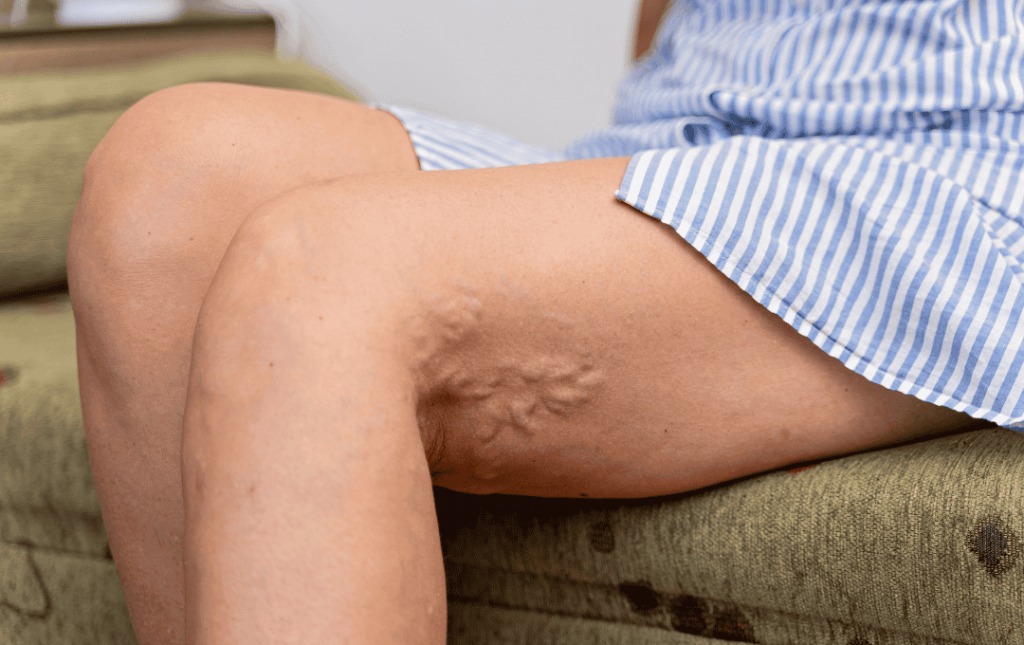 Raising Awareness of DVT and Vein Disease