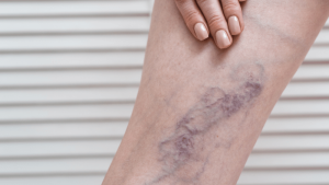 Signs and Symptoms of Chronic Venous Insufficiency