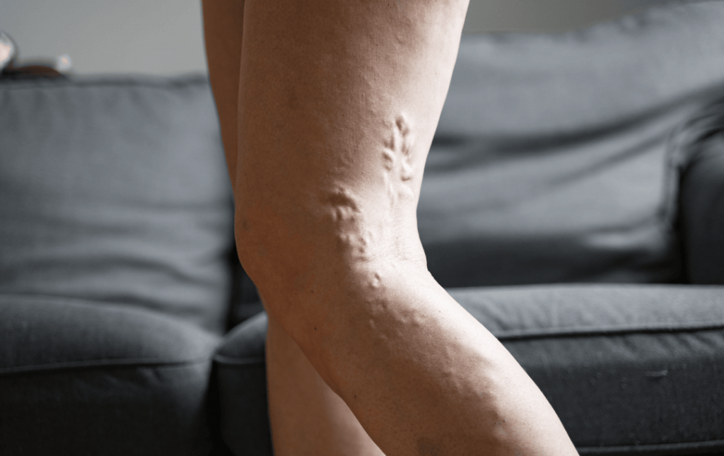 What Does Chronic Venous Insufficiency Look Like