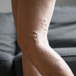 What Does Chronic Venous Insufficiency Look Like? 11 What Does Chronic Venous Insufficiency Look Like