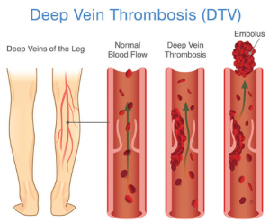 What Is Deep Vein Thrombosis and What Causes It